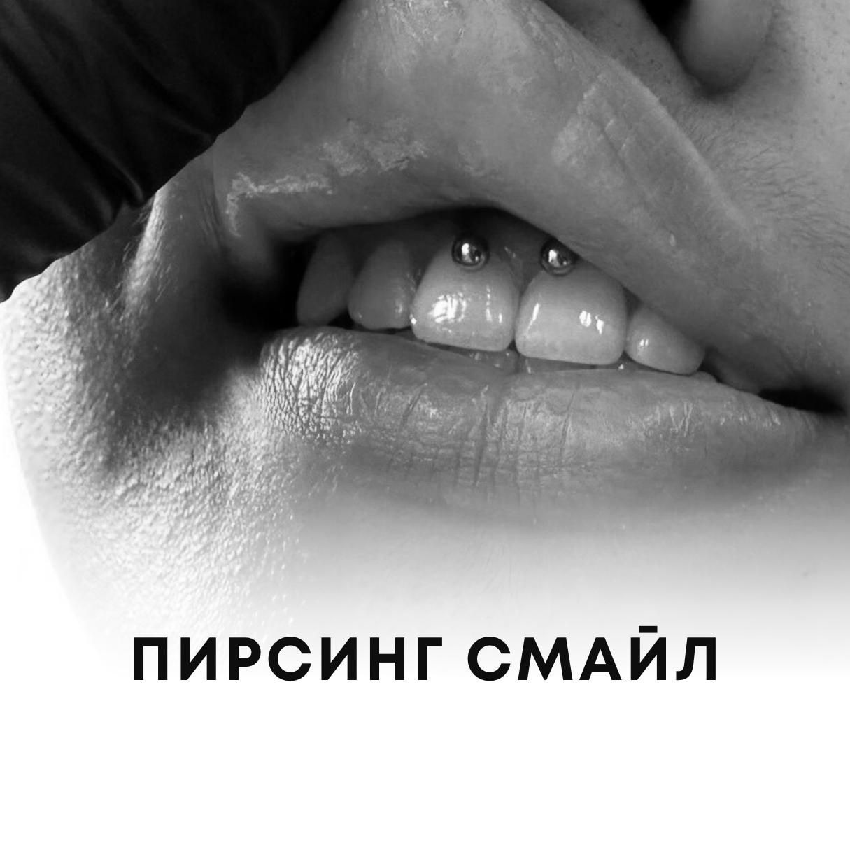 Прокол Смайл