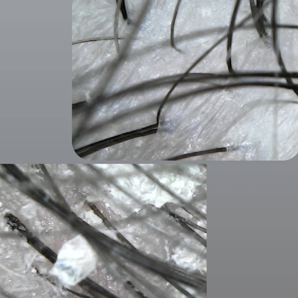 Пилинг кожи головы