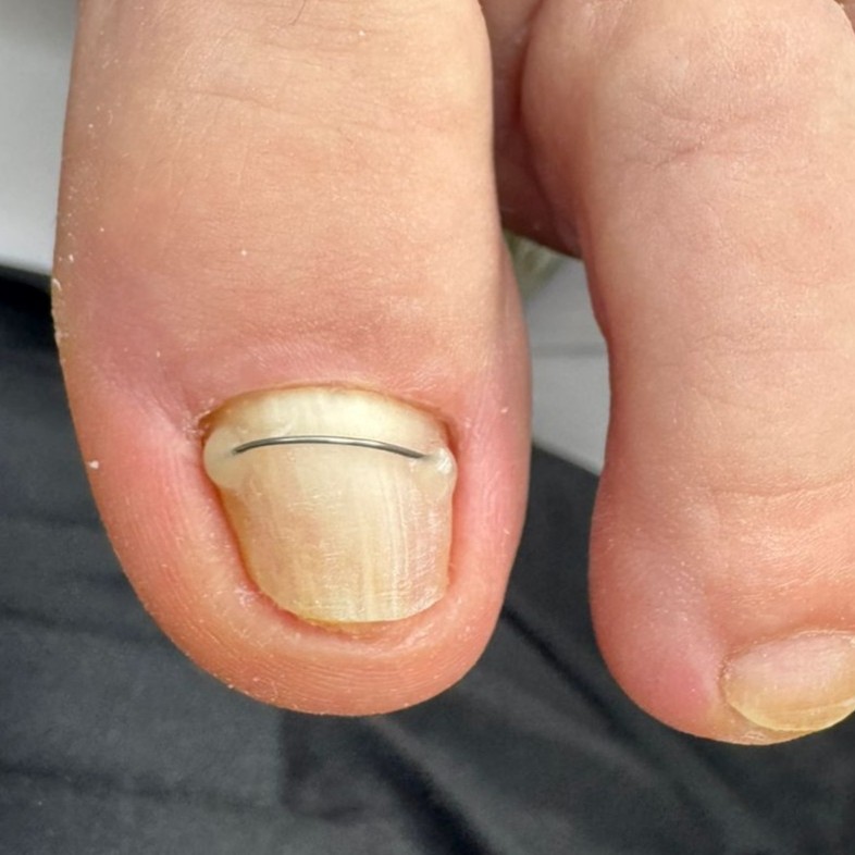 Корректирующяя система - титановая нить