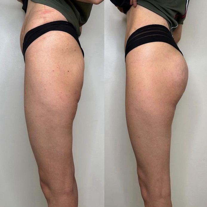 Увеличения ягодиц