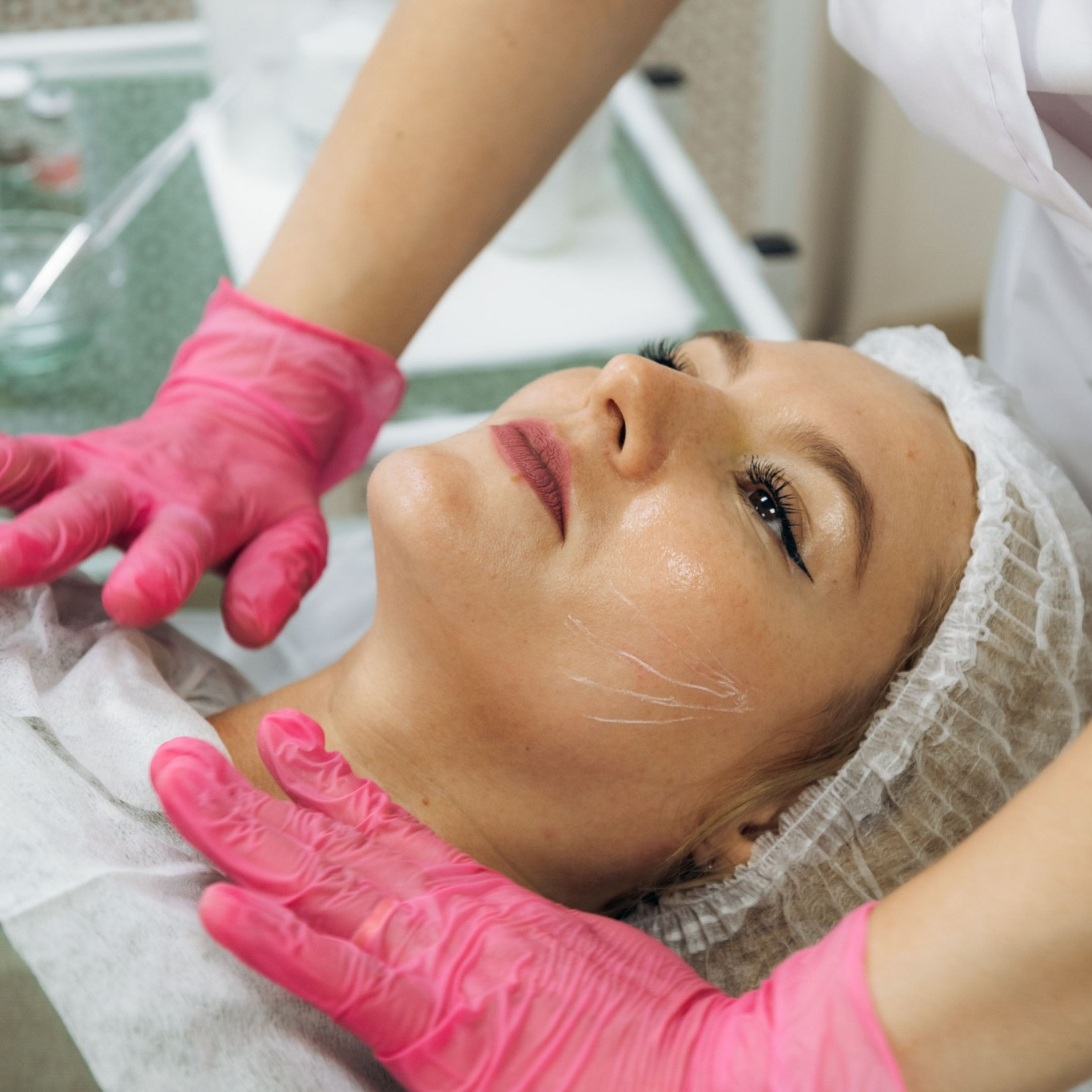 Химический пилинг