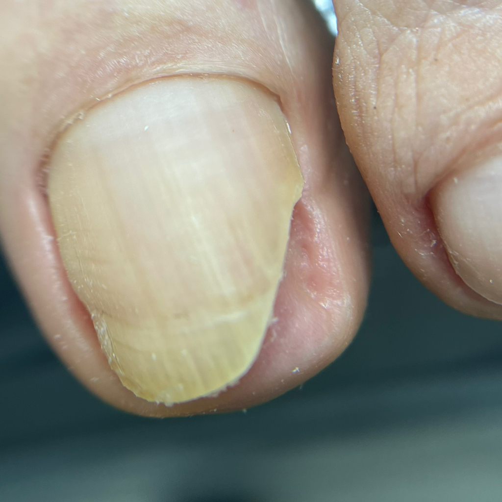 Зачистка онихолизиса