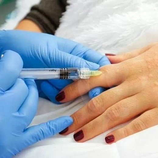 Биоревитализация кистей рук