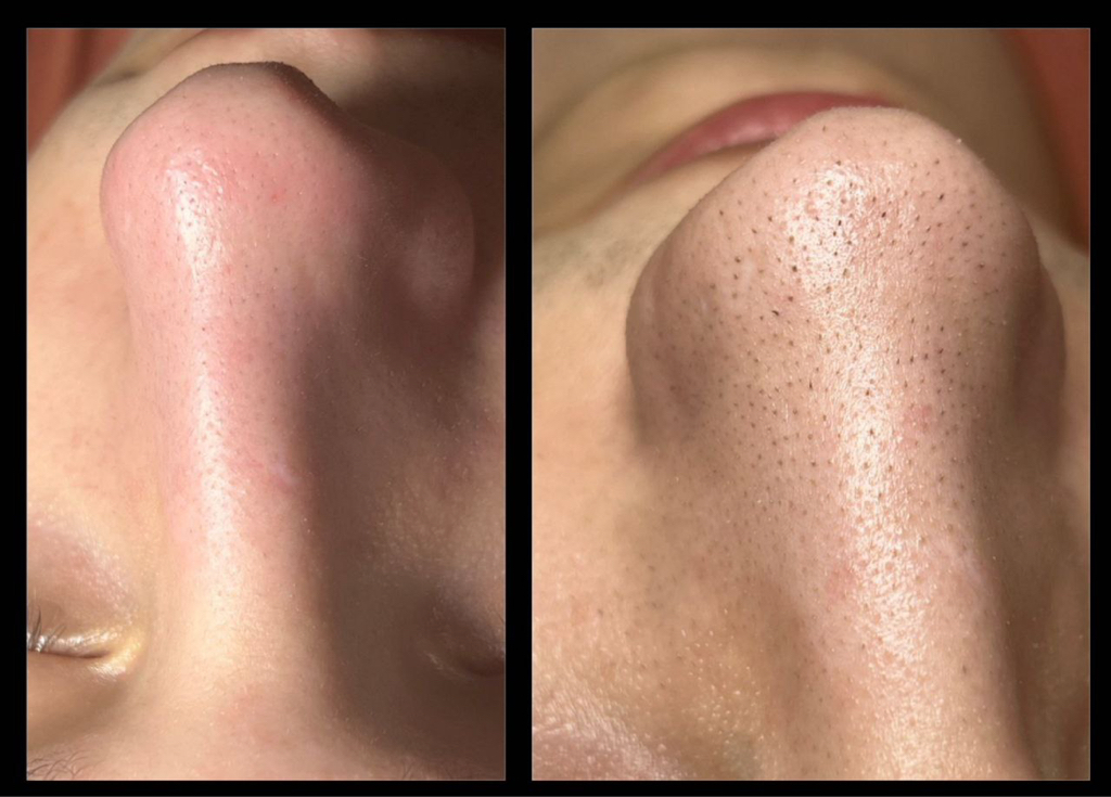 Чистка лица комплексная