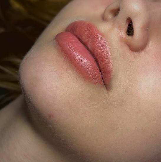 Увеличение губ.( Корея)