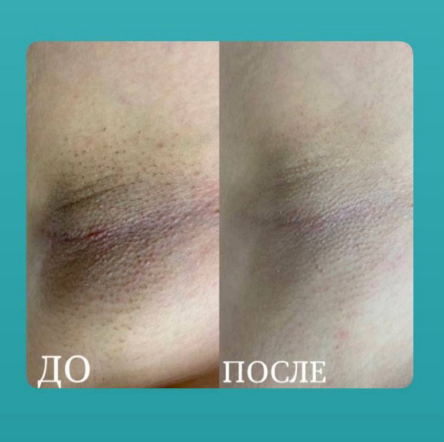 ‼️АКЦИЯ на первое посещение стан‼️ Подмышечные впадины 
БЕСПЛАТНО