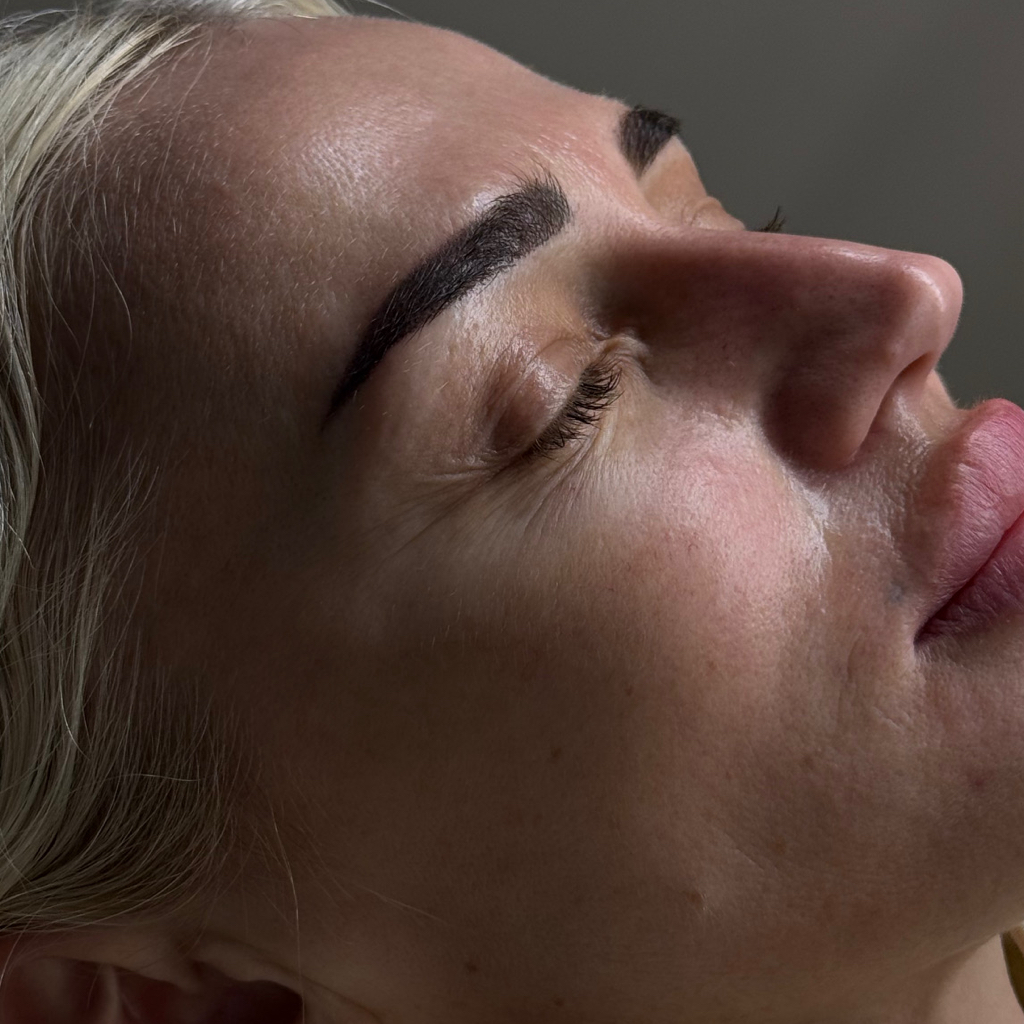 Биоревитализация