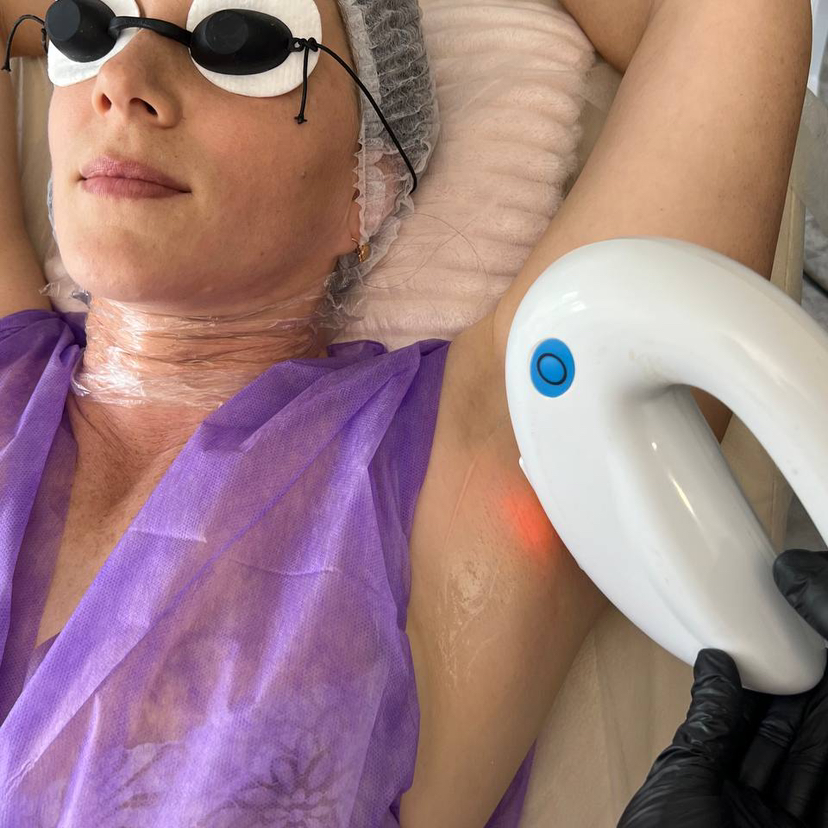 Лазерная эпиляция