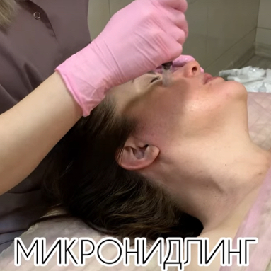 Фракционная мезотерапия по лицу 👉Микронидлинг