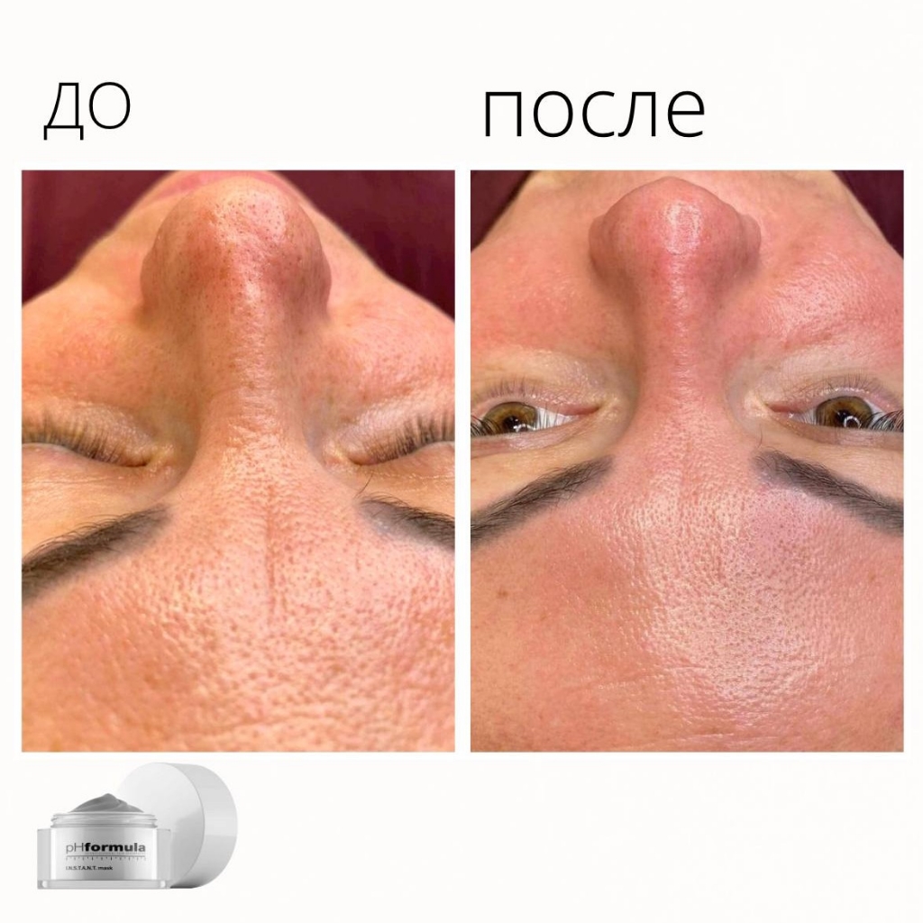 Пилинг - дермабразия Dermabrasion PhFormula
