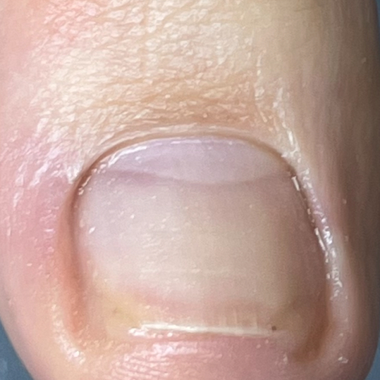 Установка силиконовой тампонады