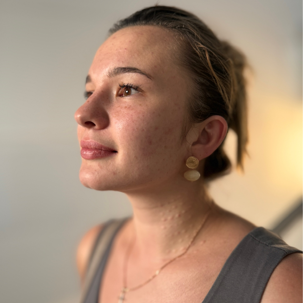 Биоревитализация (лицо)