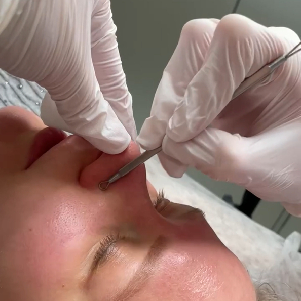 Инструментальная (механическая) чистка лица