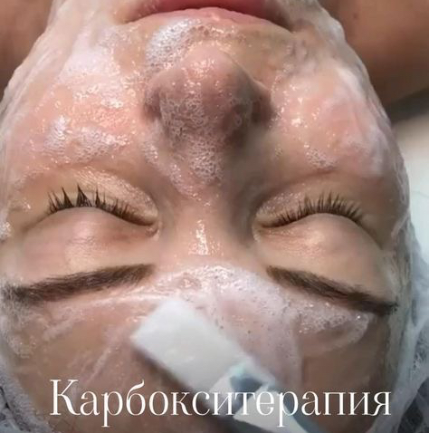 Карбокситерапия неинвазивная+маска