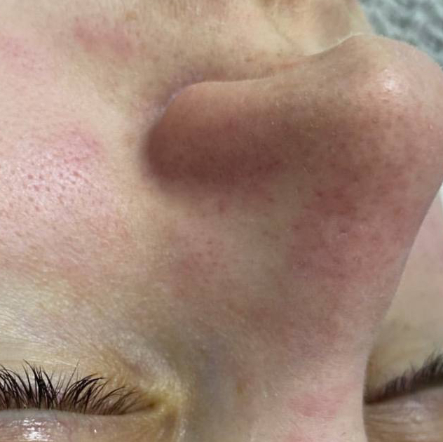 Чистка лица