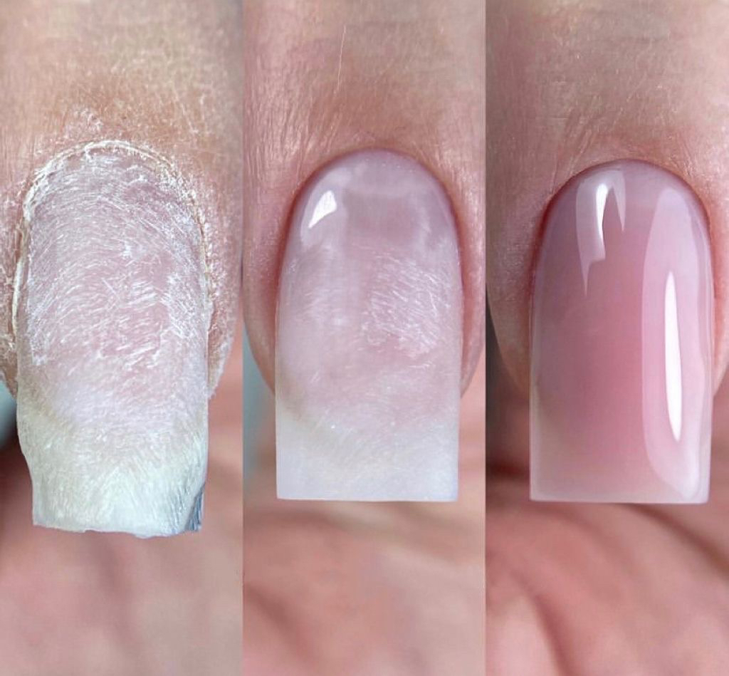 Ремонт одного ногтя