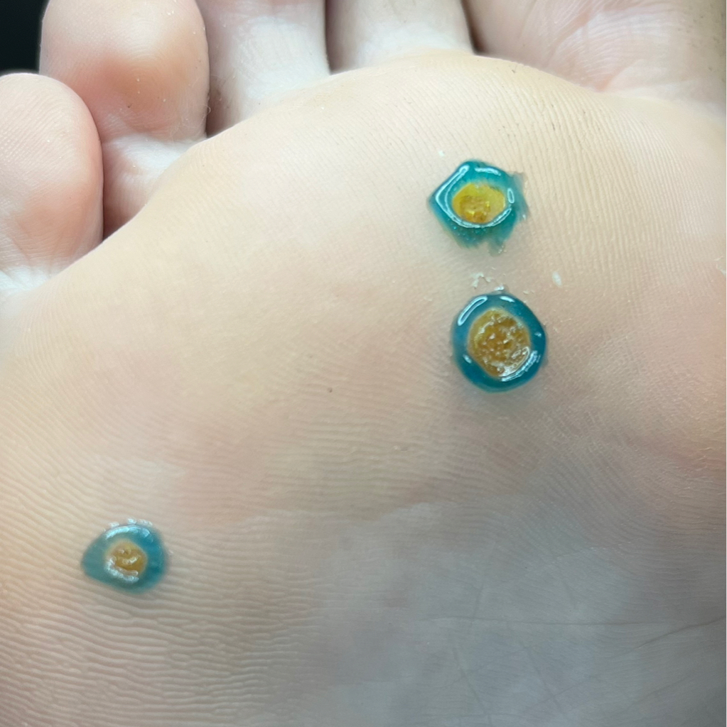 Обработка бородавок