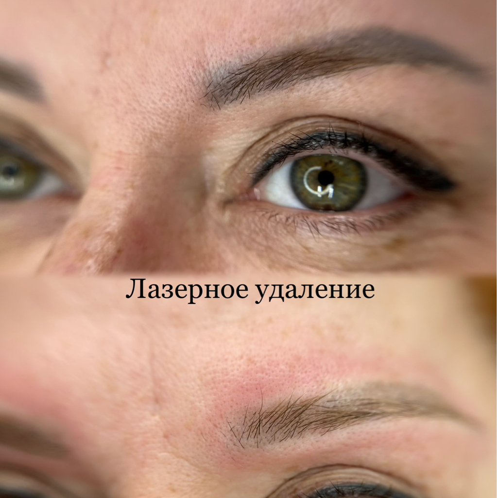 Лазерное удаление тату татуажа
