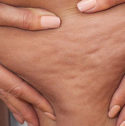 Ручной антицеллюлитный массаж всего тела/несколько зон (60 мин)