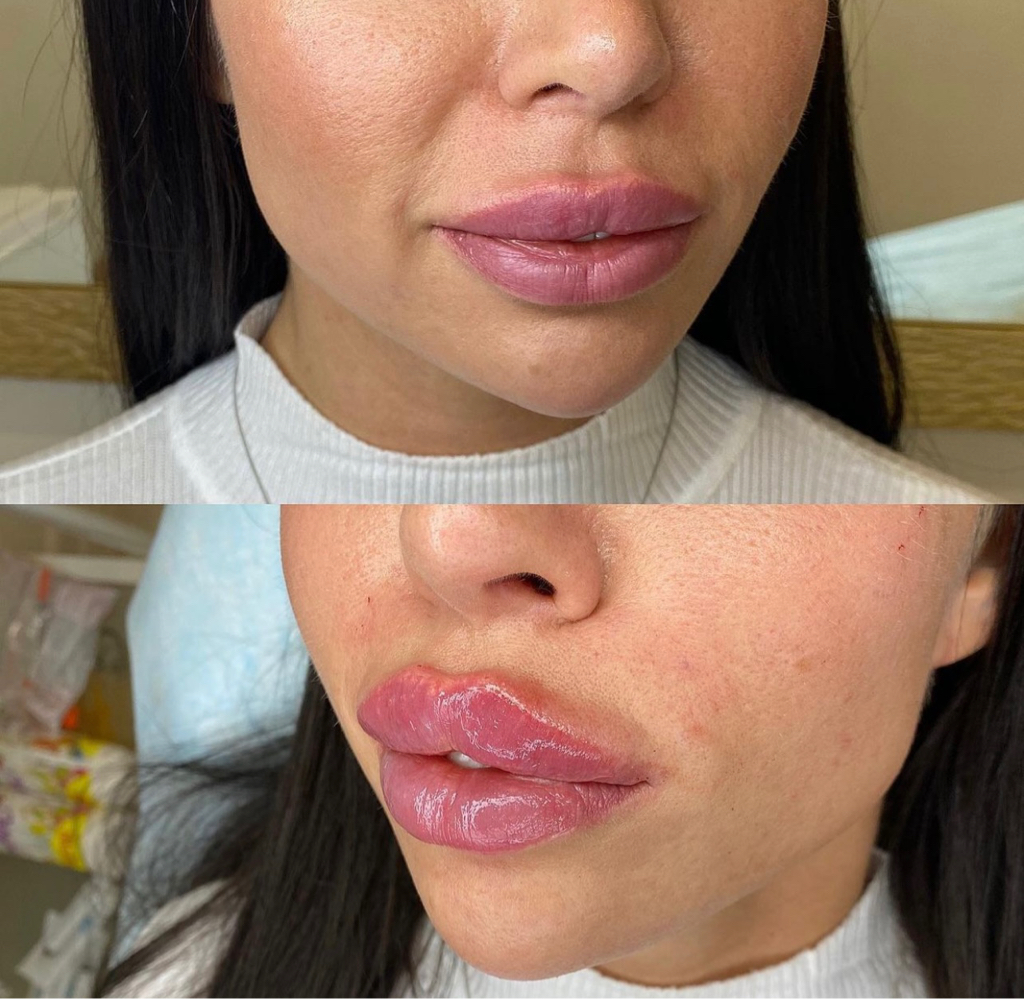 Увеличение губ филлерами на основе гиалуроновой кислоты Корея 10.000 Франция Stylage16.500