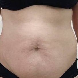 Карамельная липосакция живот