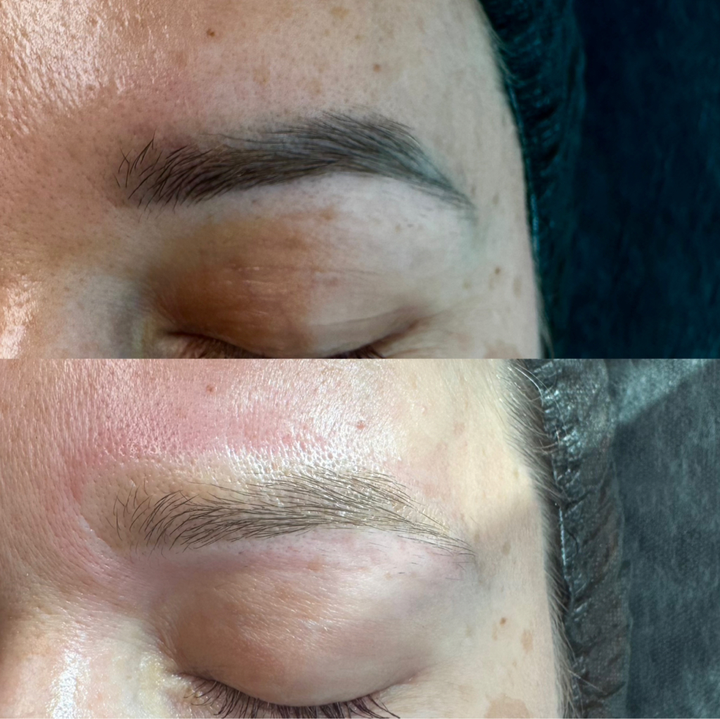 Удаление лазером