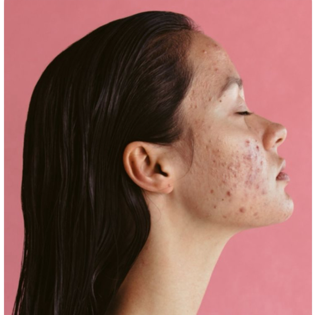 Программа «Стоп акне»