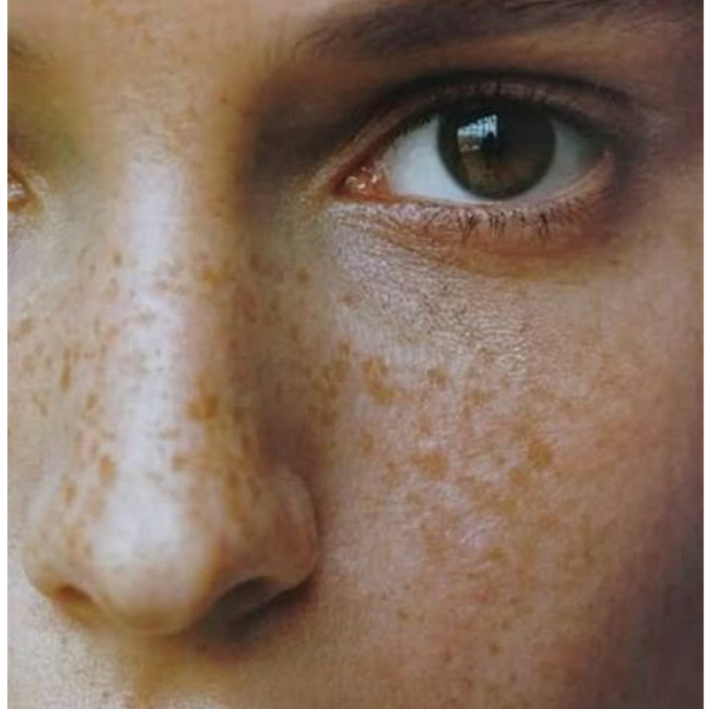 Программа «Стоп пигментация»