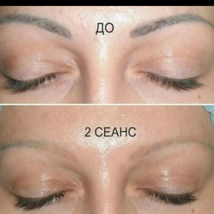 Удаление татуажа ремувером