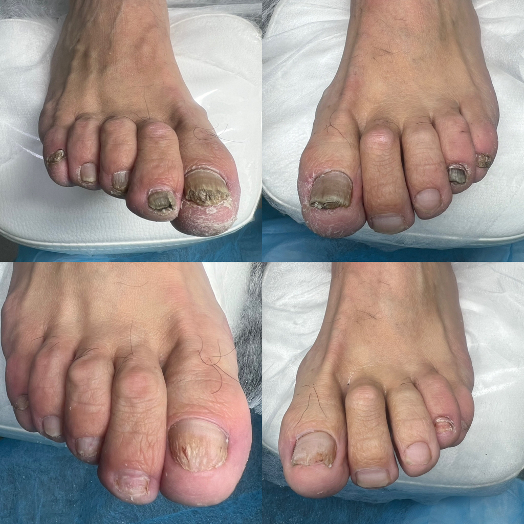 Подологический педикюр