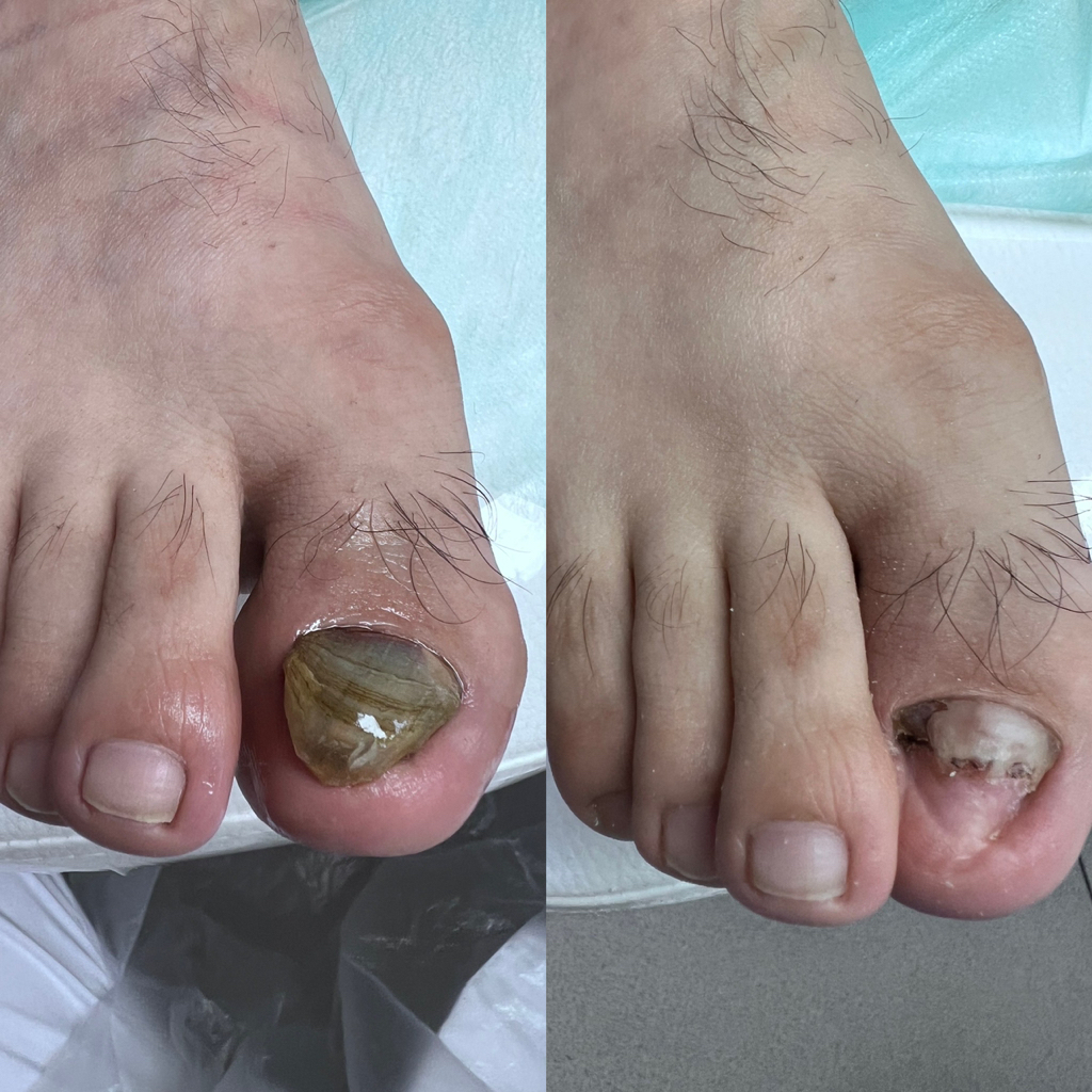 Зачистка ногтевой пластины 1 единица