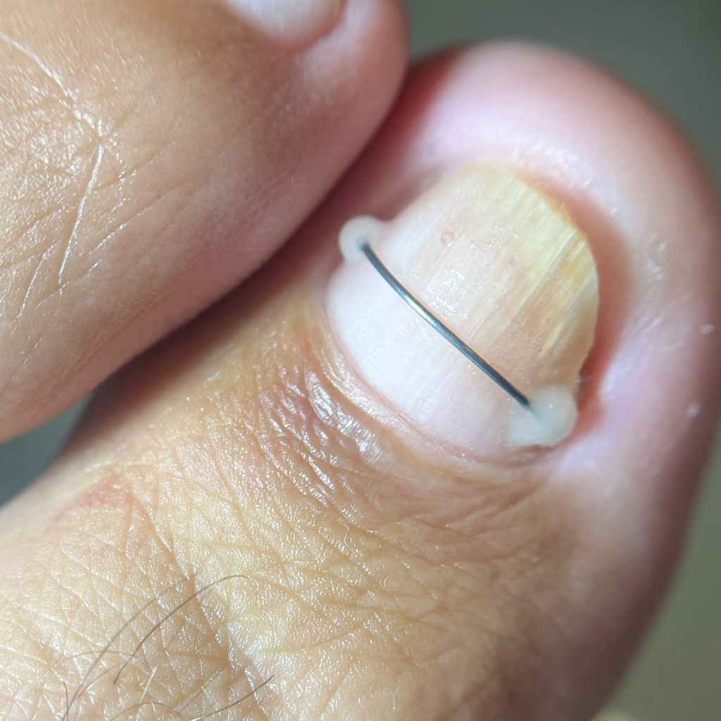 Установка коррекционной системы Титановая нить