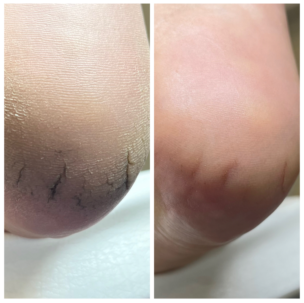 Обработка только стопы