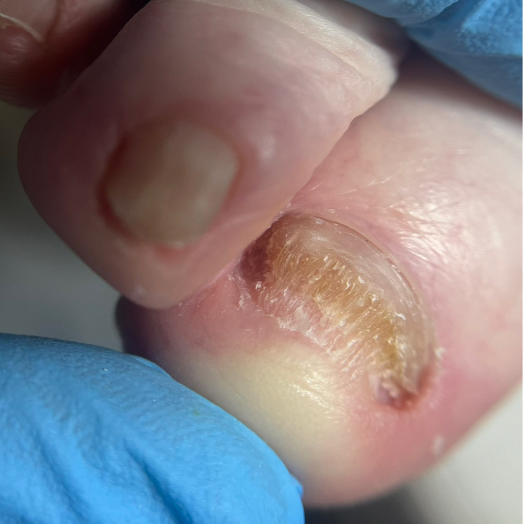 Педикюр повышенной сложности(зачистка онихолизиса, обработка трещин, стержневых мозолей, натоптышей)