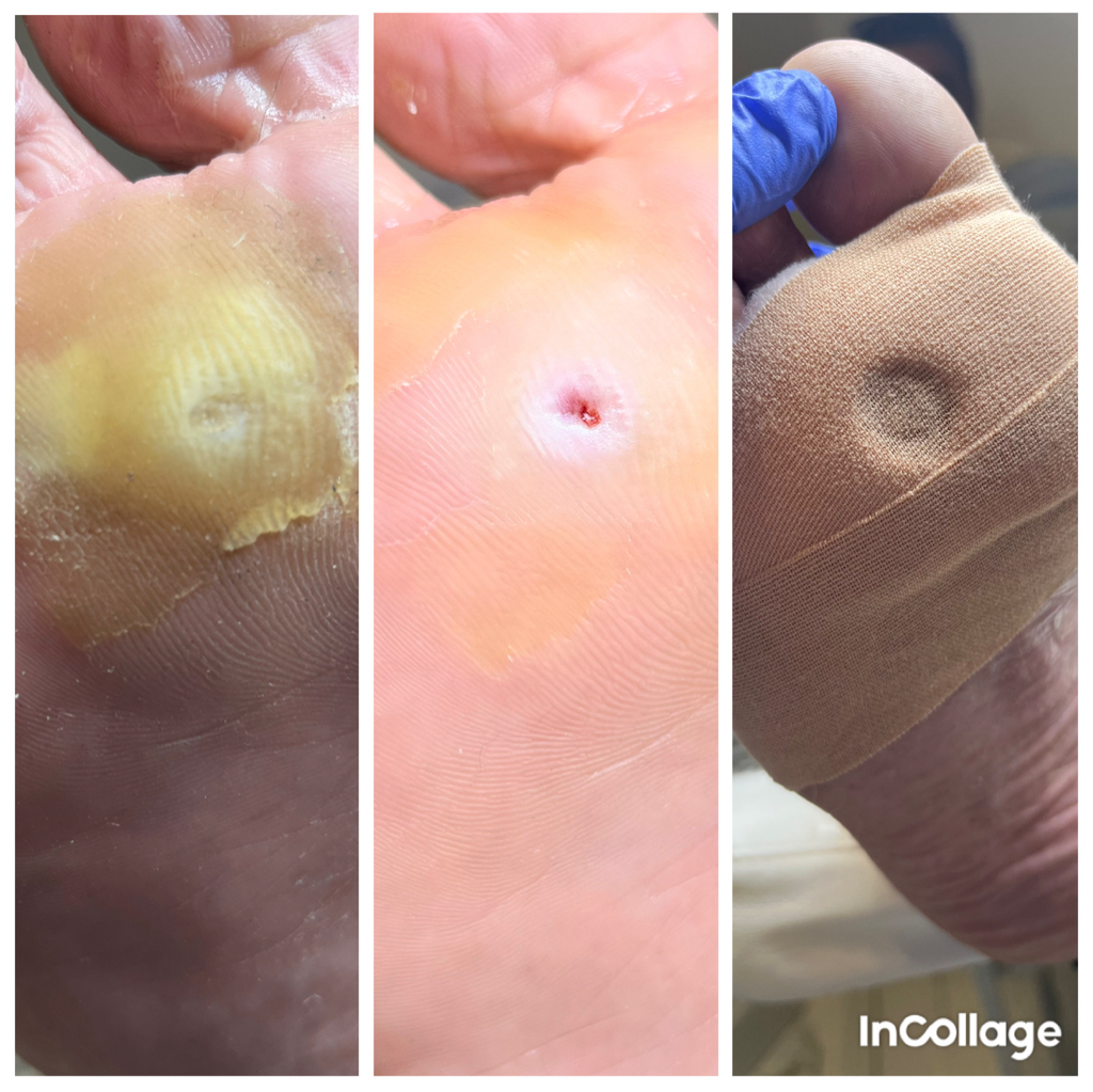 Обработка проблемной зоны на стопе (натоптыши, стержневые/межпальцевые мозоли)