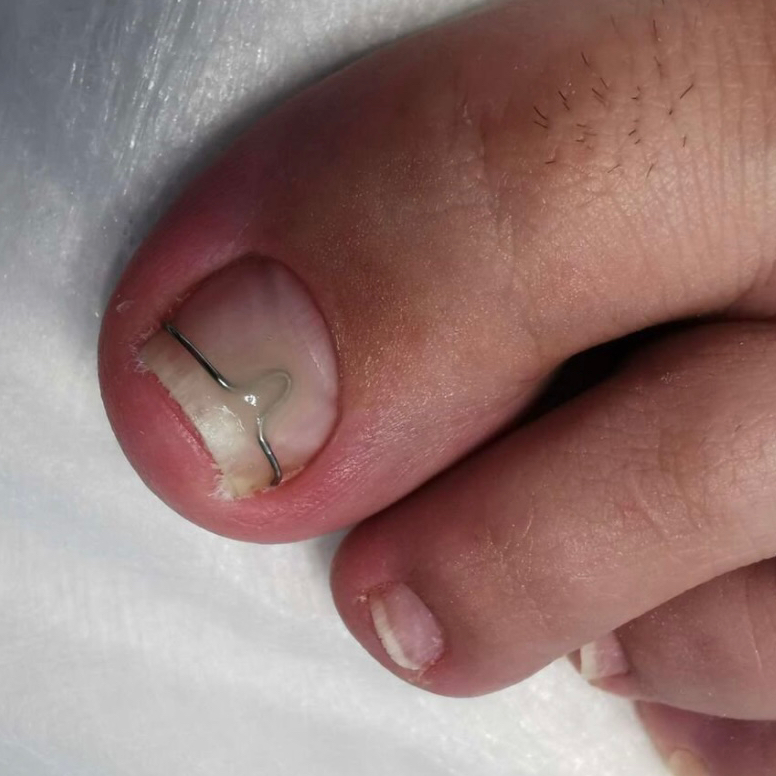 Установка крючковой корекционной системы (скоба Фрезера)