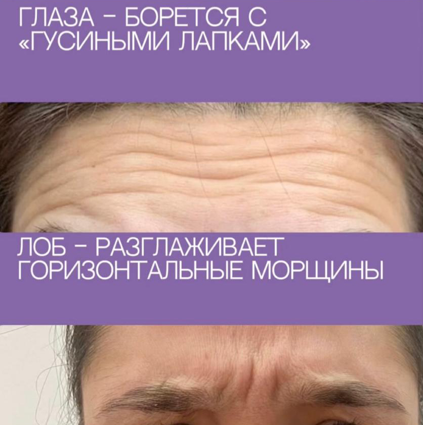 Ботокс диспорт