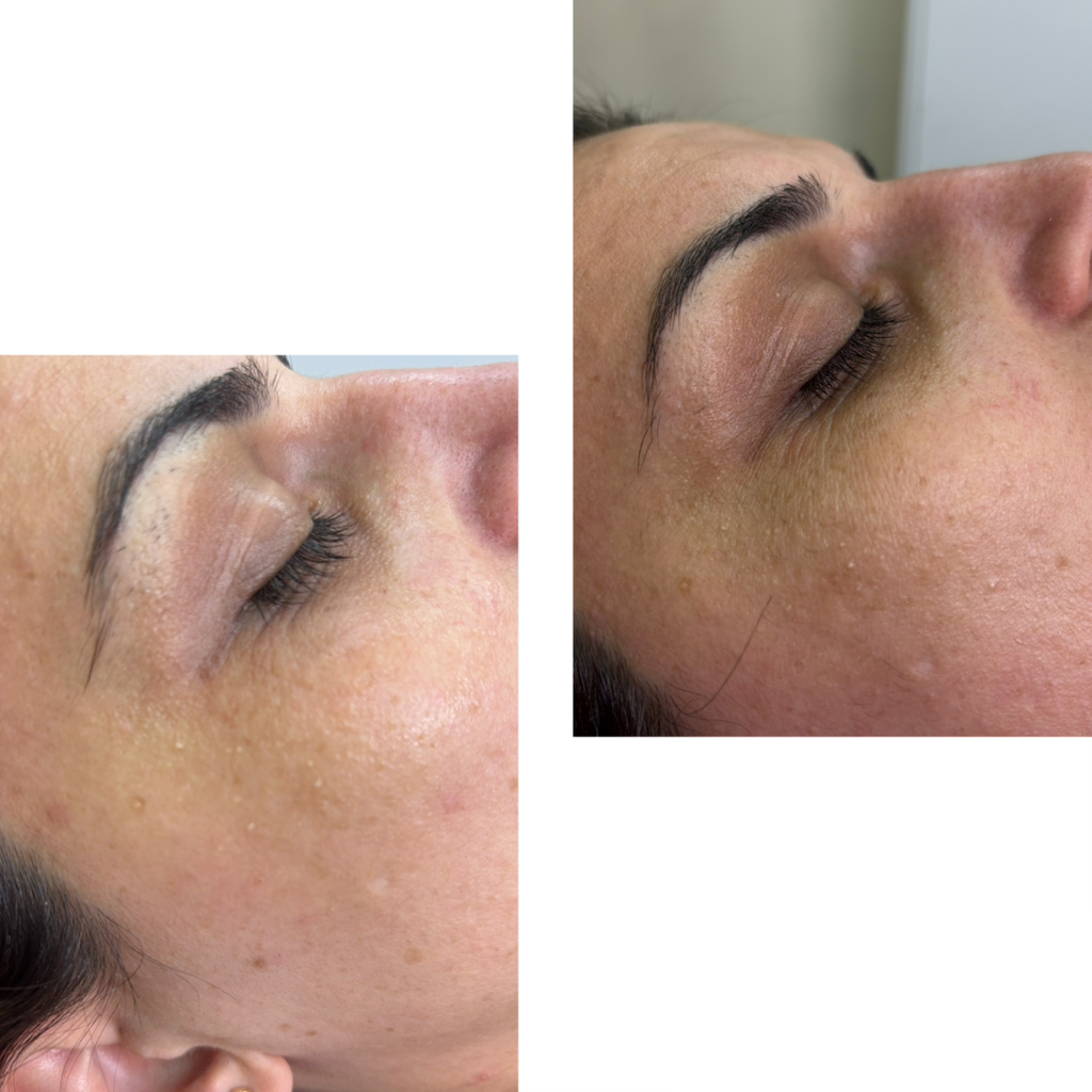 Юфора  вокруг глаз 2.0