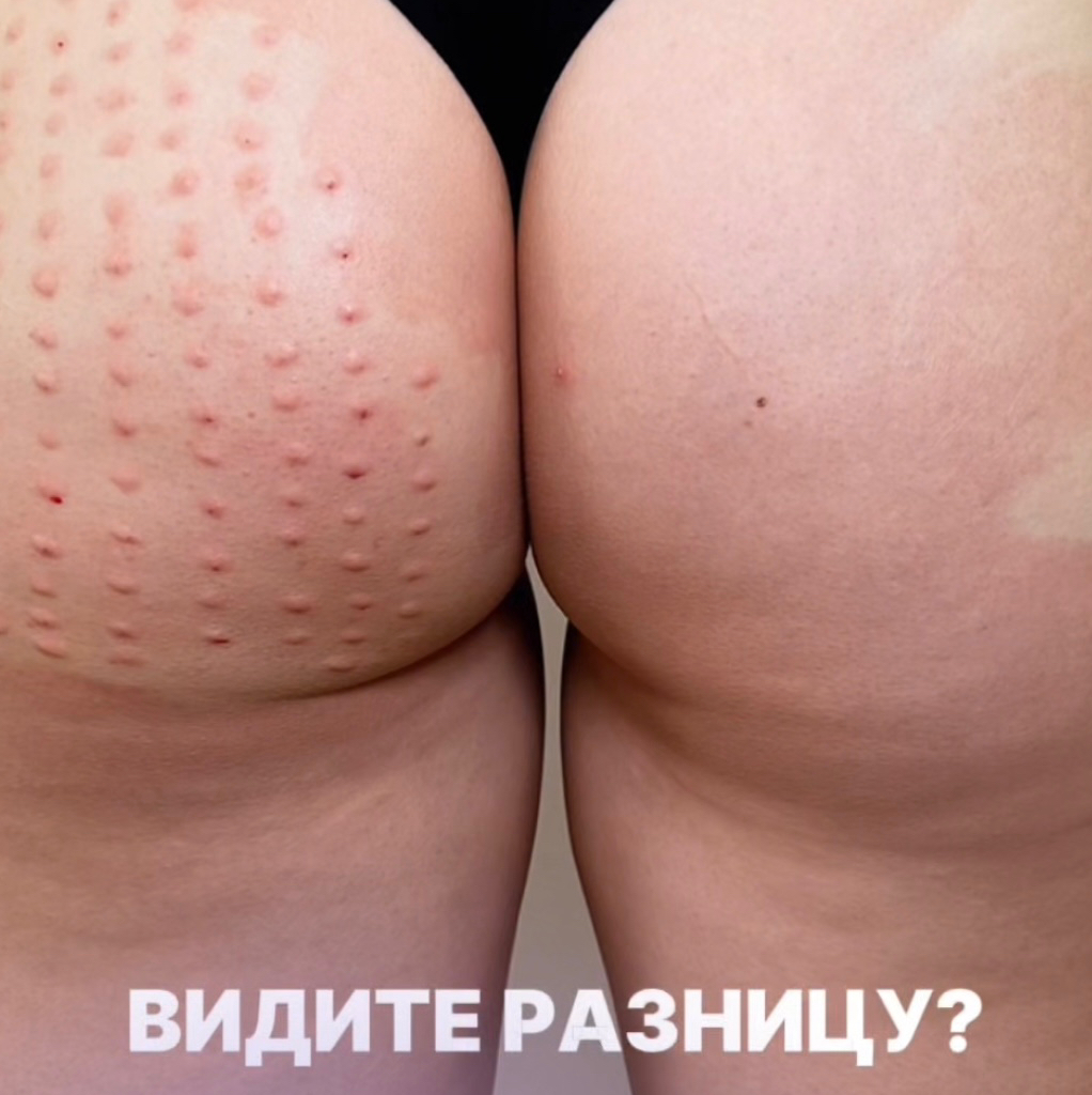 Биогель голд для ягодиц