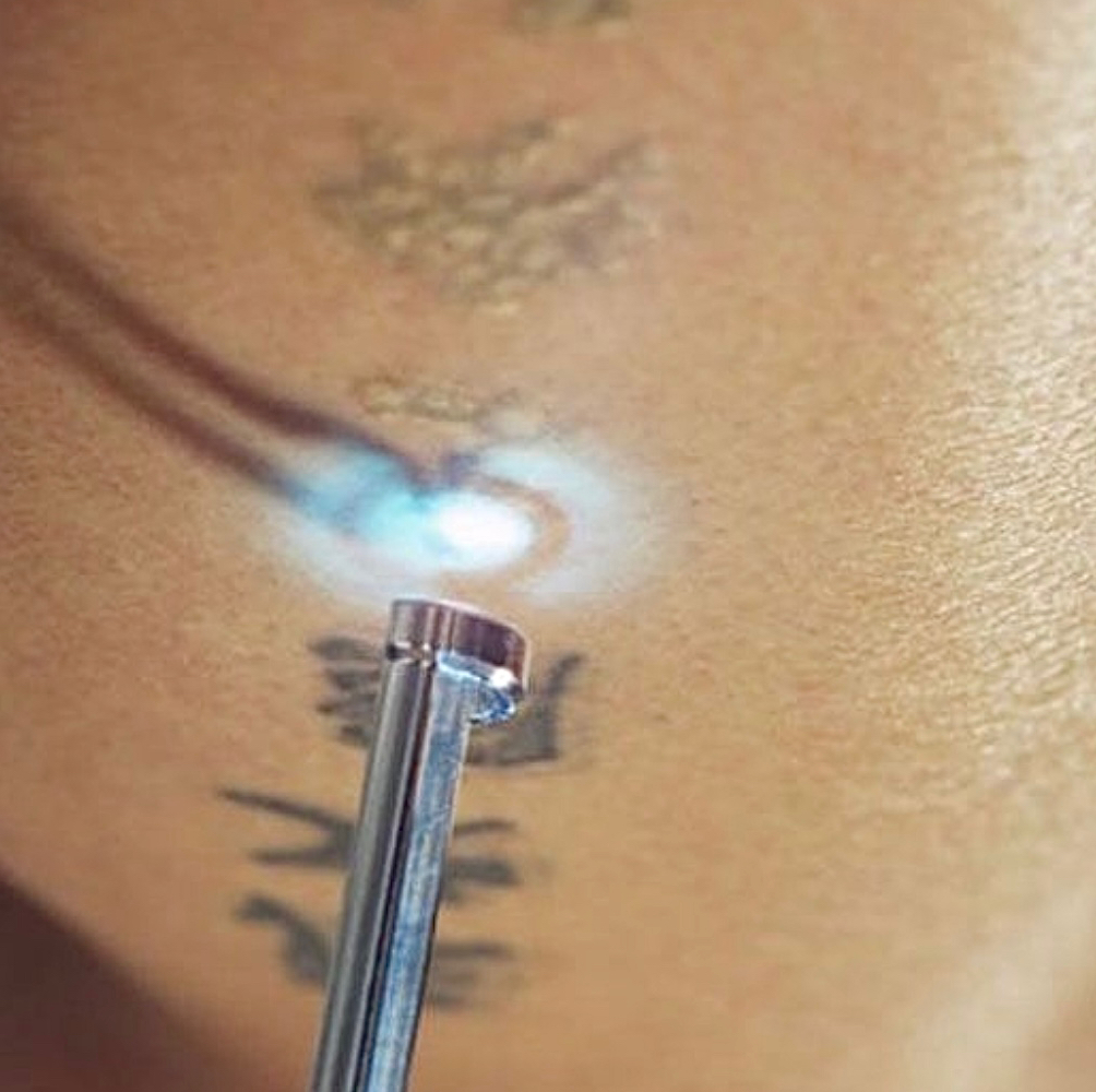 Лазерное удаление тату