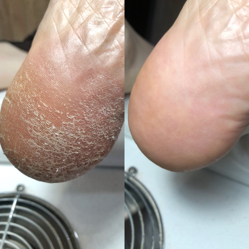 Педикюр «сложная стопа» с покрытием лак/гель-лак*