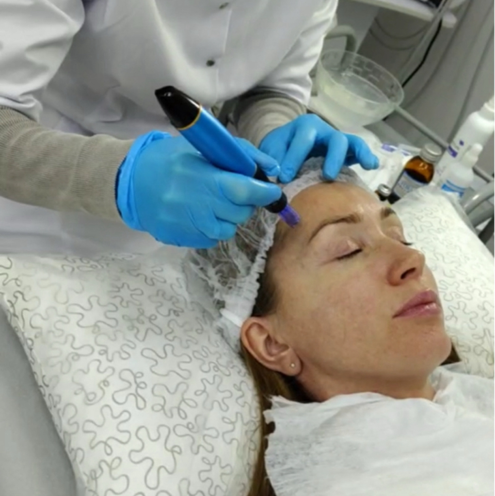 Микроигольчатое воздействие с активными коктейлями