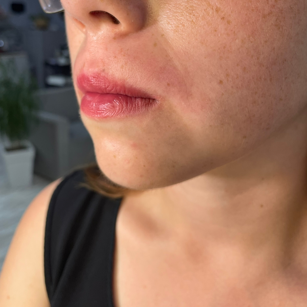 Депиляция лица