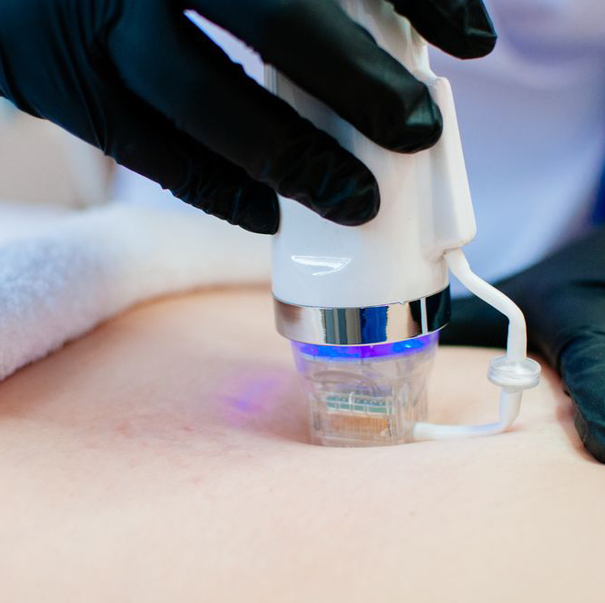 RF-лифтинг / Колени