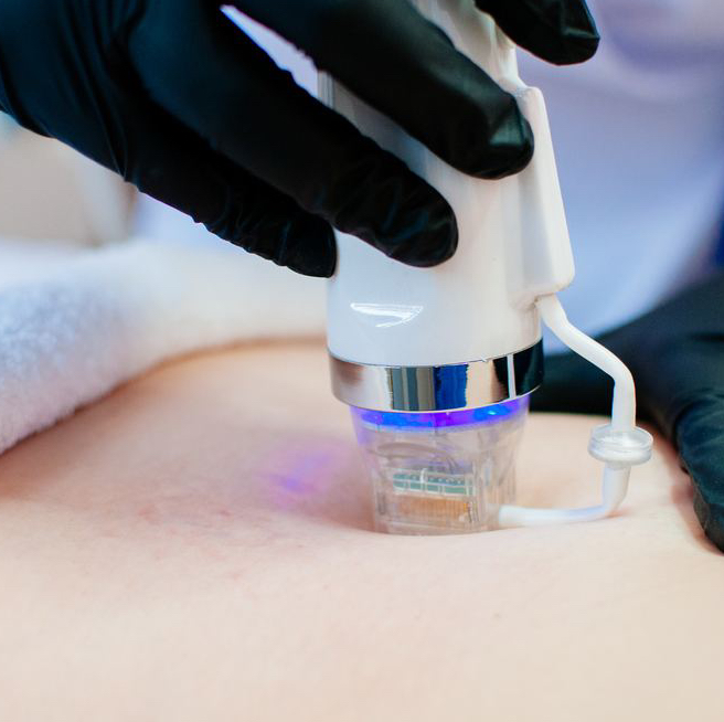 RF-лифтинг / Живот