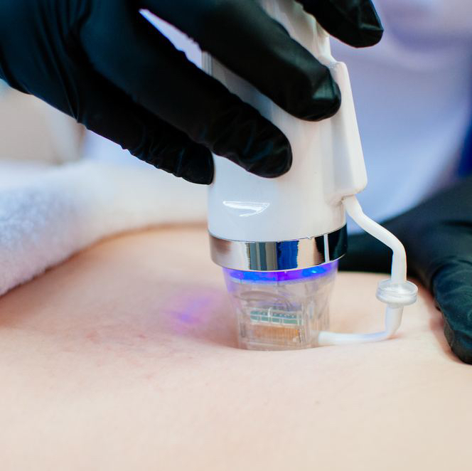 RF-лифтинг / Подъягодичная складка