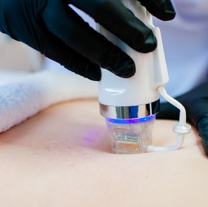 RF-лифтинг / Кисти рук