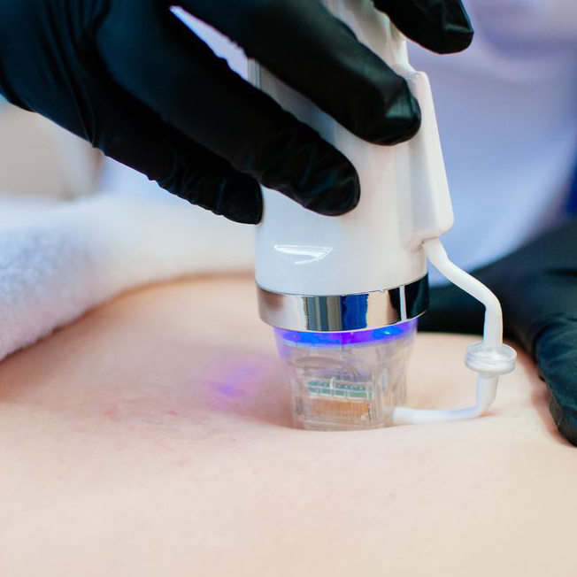 RF-лифтинг / Руки до локтя