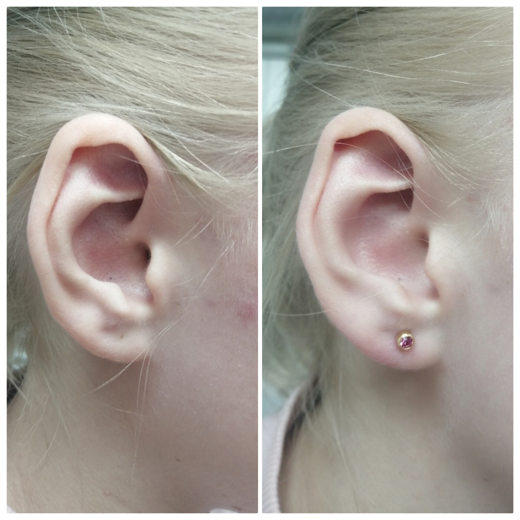 Пирсинг одной мочки уха системой 75