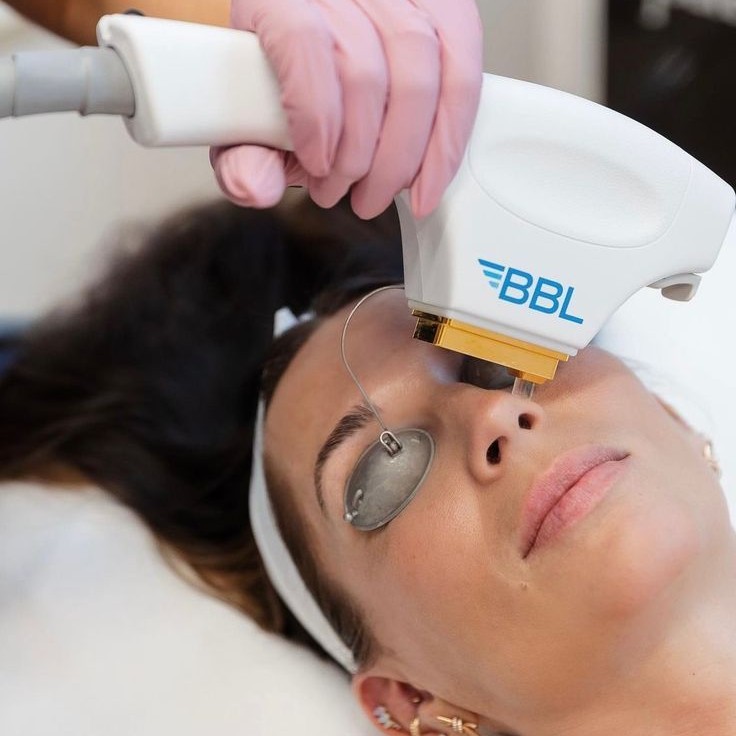 Фотоомоложение BBL (Омоложение лицо+шея)